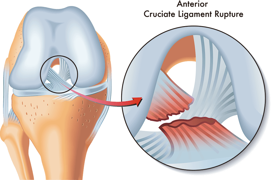 Me he roto el ligamento cruzado anterior (LCA), ¿me tengo que operar?